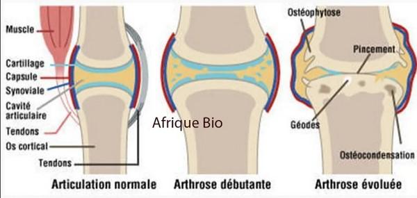 Arthose de genou afrique bio