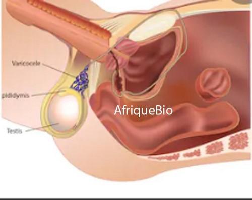 Varice aux Testicules, Traitement Varicocèle qui marche