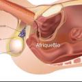 Varice aux Testicules, Traitement Varicocèle qui marche