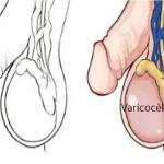 varices testicules, Plantes Soigner Varicocèle
