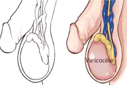 varices testicules, Plantes Soigner Varicocèle