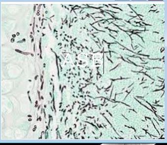 Aspergillose pathologie