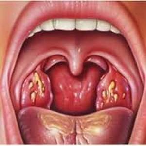 Cancer de gorge symptome