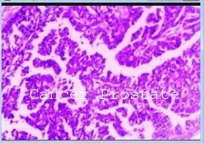 Cancer prostate adenocarcinome