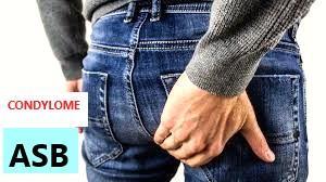 COMMENT GUÉRIR LE CONDYLOME, CAUSE ET SYMPTÔME DE CONDYLOME
