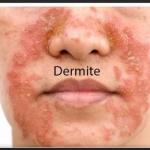 Dermite de visage