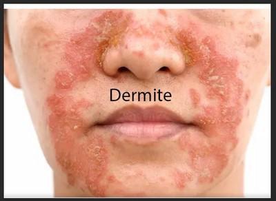 Dermite de visage