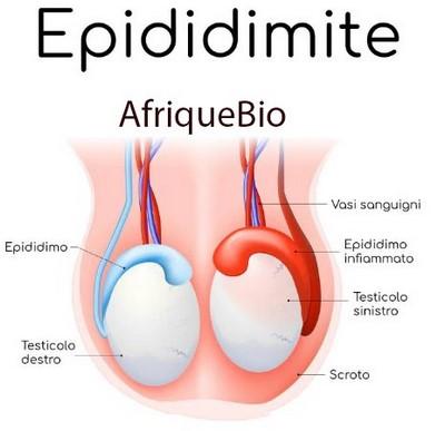 Epididymite maladie homme