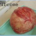Fibome myome