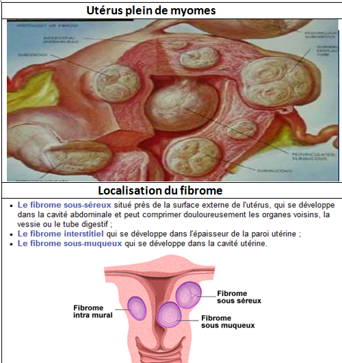 Fibromes en image