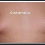 Gynecomastie homme