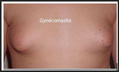 Gynecomastie homme