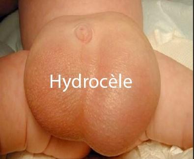 Hydrocèle des testicules, Enlever hydrocèle Naturellement