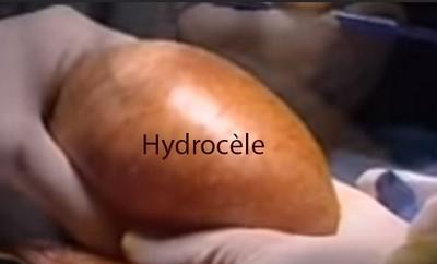 Hydrocele maladie homme