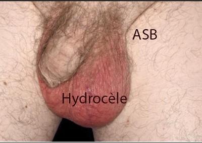 Hydrocele testiculaire