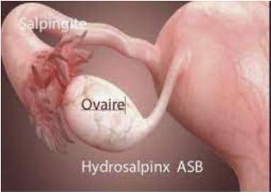 Hydrosalpinx natural treatment Hydrosalpinx