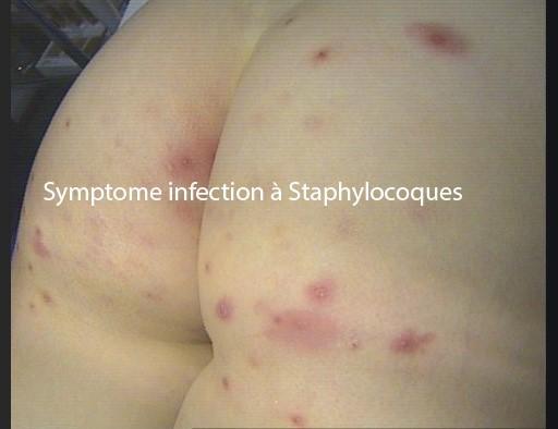 staphylococus infection  symptoms