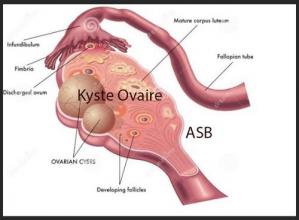 Ovarian Cyst, Natural Remedies Internal Tumors Ovarian Cyst