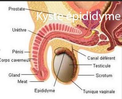 Kyste épididyme, Remède Guérir Kyste des Testicules