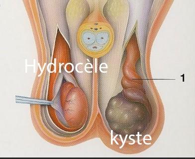 Kyste et hydrocèle, Traitement Naturel Kyste au Testicule