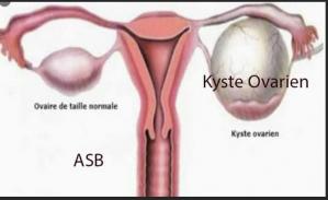 Kyste ovarien femme, Remède Naturel Kyste Ovarien