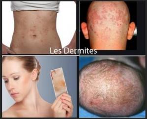 Les dermites, Traitement par la Plante