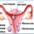 Les differents types de fibrome