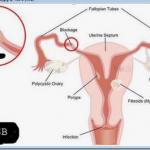 Maladies de la femme
