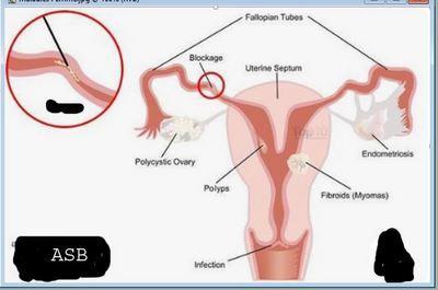 Maladies de la femme