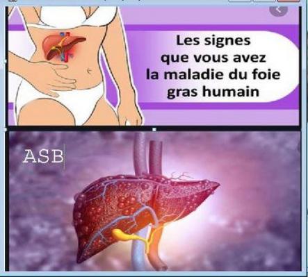 Maladies du foie Remède Naturel Foie Engorgé