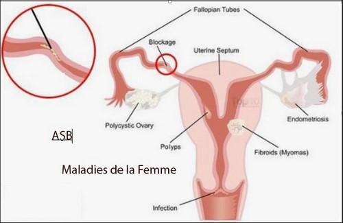 Maladies femme fibrome trompe ovaire
