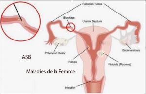 Maladies femme fibrome trompe ovaire