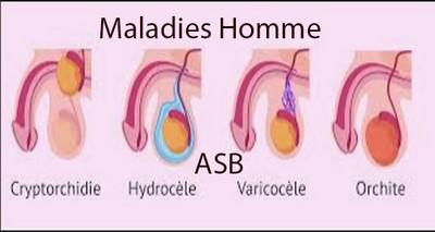 Maladies homme, Hydrocèle, Varicocèle, épididymite