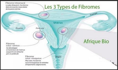 les 3 types de fibromes et Enlever Fibrome Naturellement