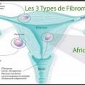 les 3 types de fibromes et Enlever Fibrome Naturellement