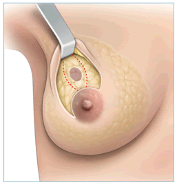 Operation chirugicale du cancer de sein