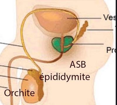 Orchite épididymite, Douleur aux testicules