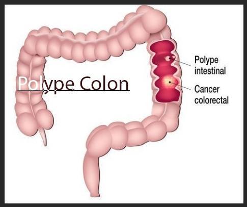 Polype colon ? remède naturel Polype Colon