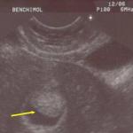 Polype diagnostic