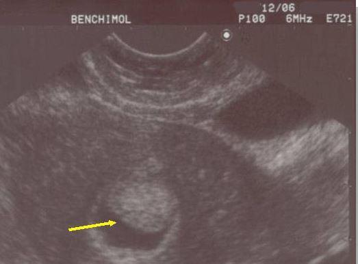 Polype diagnostic