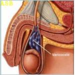 Remede 058 varicocele