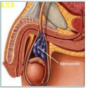 Remede 058 varicocele