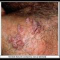 Remede naturel condylome verrue genitale