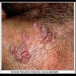 Remede naturel condylome verrue genitale