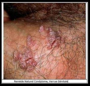 Remede naturel condylome verrue genitale