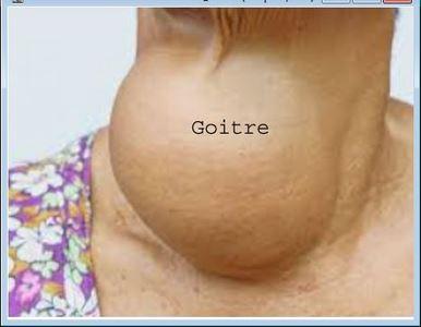 Remède naturel goitre Traitement Naturel Goitre