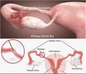 Salpingite maladies femmes, Traitement Naturel  Salpingite