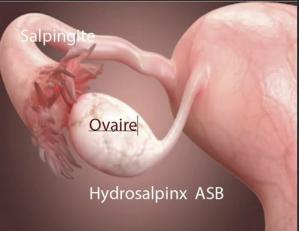 Sapingite hydrosalpinx, Remède Naturel Salpingite