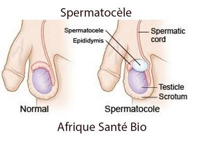 Spermatocele remede naturel