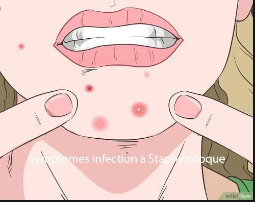 Staphylococus symptoms